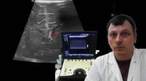 Детское УЗИ головного мозга (нейросонография) - Флотация в боковом желудочке