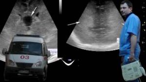 Нейросонография - Повышение перивентрикулярной эхогенности