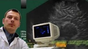 Нейросонография (УЗИ головного мозга) - Дисгенезия мозолистого тела