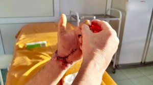 Сургутянину пришили руку после травмы от болгарки