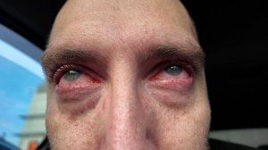 Обострение. Сильно горят глаза. Что делать не знаю. Сильная боль. Жизнь в диагнозе. Рак крови. Онко