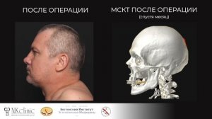 Установка титановой пластины после электротравмы