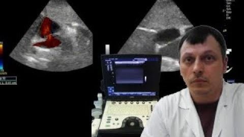 Детская Эхокардиография - Межпредсердное сообщение смотреть онлайн