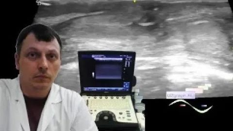 Детское УЗИ мошонки - Состояние после операции на мошонке 2 смотреть онлайн