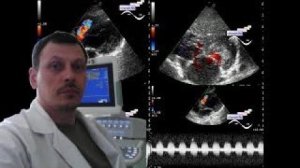 Детское УЗИ сердца (эхокардиография) - Дефект межжелудочковой перегородки (ДМЖП)