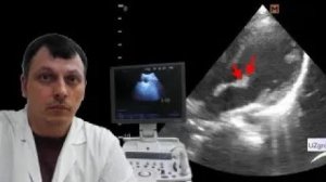 Детская Эхокардиография (УЗИ) - Миксоматозная дегенерация митрального клапана сердца