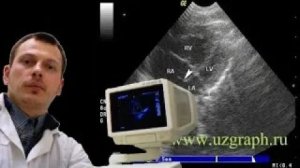 Детское УЗИ сердца (эхокардиография) - Увеличение правого сердца