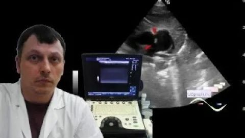 Детское УЗИ сердца (эхокардиография) - Дефекты визуализации границ смотреть онлайн