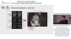 Острый гиппокампальный синдром Шевченко Е.В. 2025