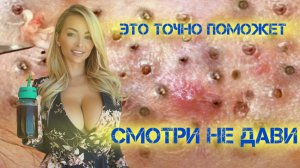 Работа косметолога Онлайн . Давим Акне Угри Прыщи