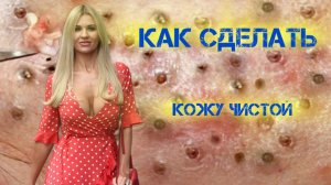 Обзор работы Косметологов. Прыщи Акне Закупорка пор . Макросьемска