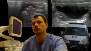 Детское УЗИ мочевыделительной системы - Мегауретер, вентильный конкремент мочеточника