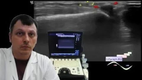 Детское УЗИ костно-мышечной системы - Шишка в проекции ключицы 2 смотреть онлайн