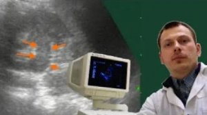 Детское УЗИ почек - Удвоение ЧЛС почки