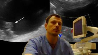 Детское УЗИ мочеточников - Реимплантация мочеточника по Коэну смотреть онлайн