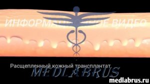 Пересадка кожи: восстановление поврежденной кожи