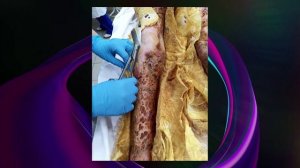 Ожоговый травматизм - страшно, больно и долго 16+