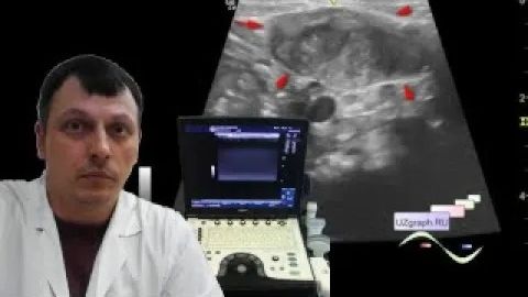 Детское УЗИ мягких тканей - Кривошея/ неоплазия смотреть онлайн