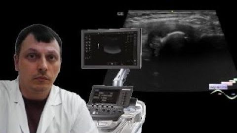 УЗИ костно-мышечной системы - Шишка в проекции ключицы смотреть онлайн