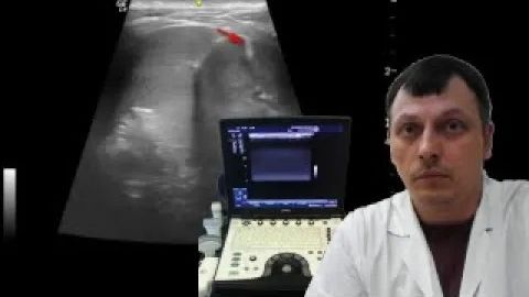 Детское УЗИ почек - Двухсторонние единичные втяжения контура почек смотреть онлайн