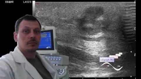 Детское УЗИ мягких тканей - Прыщик на спине смотреть онлайн