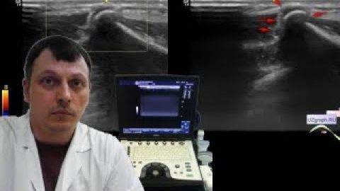 Детское УЗИ скелетно-мышечной системы (костей) - Экзостоз лопатки смотреть онлайн