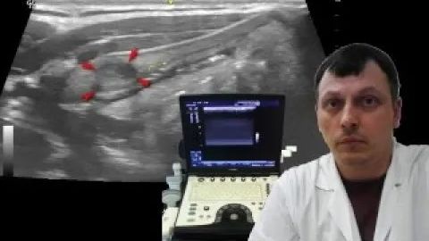 Детское УЗИ скелетно-мышечной системы - Гетерогенные включения в щитовидном хряще смотреть онлайн