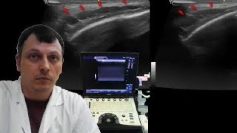 Детское УЗИ мягких тканей - Образование височной области смотреть онлайн