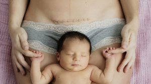 Как выглядит кесарево сечение