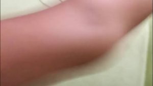 Гипермобильность_суставов_руки