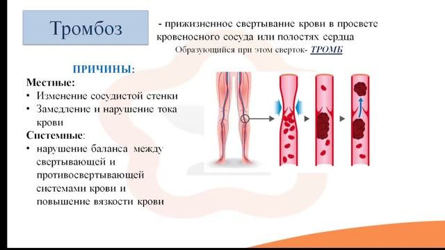 Видео-лекция №25.2. Стаз, тромбоз и эмболия смотреть онлайн