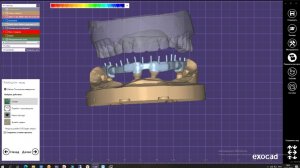 Протез на телескопических абатментах в exocad Полный курс от Бачулиса Олега. Цифровое протезирование