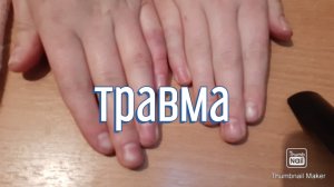 Ушиб или перелом?