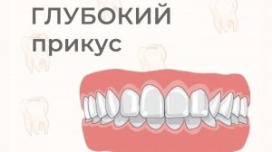 Глубокий прикус