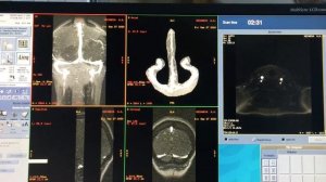 Реконструкция вен головного мозга на МРТ: