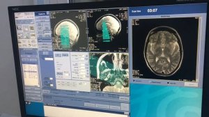 МРТ височно‑нижнечелюстного сустава (ВНЧС): методика сканирования и анализ изображений