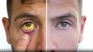 Аппарат Импловит, «Катушка Мишина». Помощь при Гепатитах и заболеваниях печени.