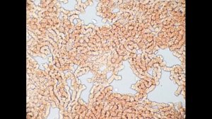 Состояние крови до и после употребления крепкого спиртного.