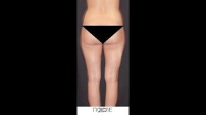 РУЧНАЯ ПЛАСТИКА ТЕЛА NEWBODYKA. КОРРЕКЦИЯ ФИГУРЫ. КАЛИНИН АЛЕКСЕЙ. РЕЗУЛЬТАТ ДО И ПОСЛЕ. ВИДЕО 2(1)