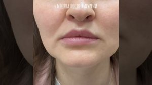 Лифтинг верхней губы