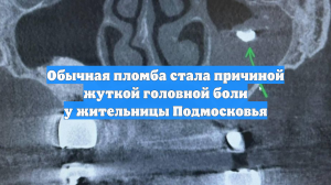 Обычная пломба стала причиной жуткой головной боли у жительницы Подмосковья