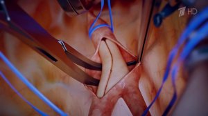 Врачи легендарного Склифа разработали новый подход к лечению тромбозов.