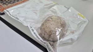 Килограммовый камень извлекли из мочевого пузыря пациента в Саратовской области