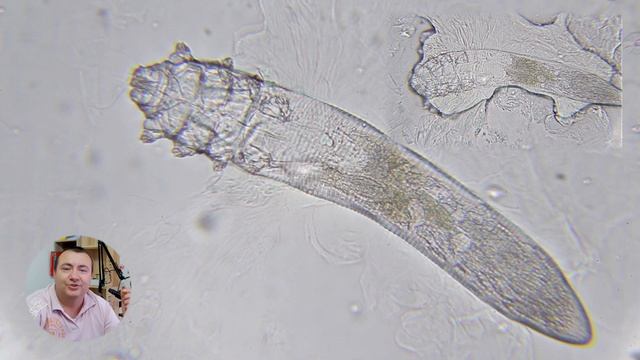 Эфирное масло гвоздики vs клещ Demodex — кто победит? ️ смотреть онлайн