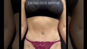 Липоабдоминопластика