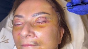 Снятие швов после блефаропластики