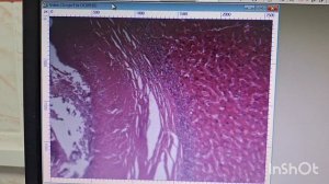 Паразитарная киста печени