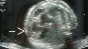 История женщины которой удалось сохранить ребенка