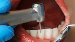 Добрый вечер) Сточили нижние зубы сняли слепки.