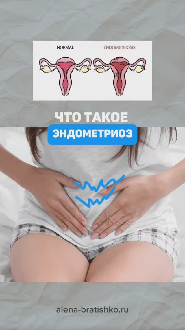 Что такое эндометриоз. Семейный доктор Алена Братишко